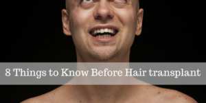 8 Things to Know before Hair transplant