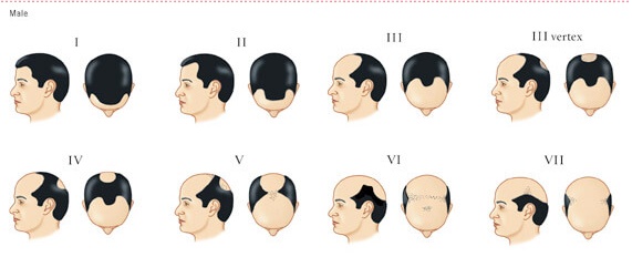8 Things to Know before Hair transplant- FUE or FUT